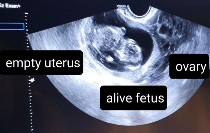 ovarian ectopic pregnancy ultrasound