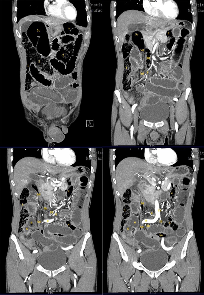 Right-side fixation of the sigmoid colon causing internal herniation with  closed-loop obstruction of both small and large bowel: a case report and  review of the literature | Journal of Medical Case Reports