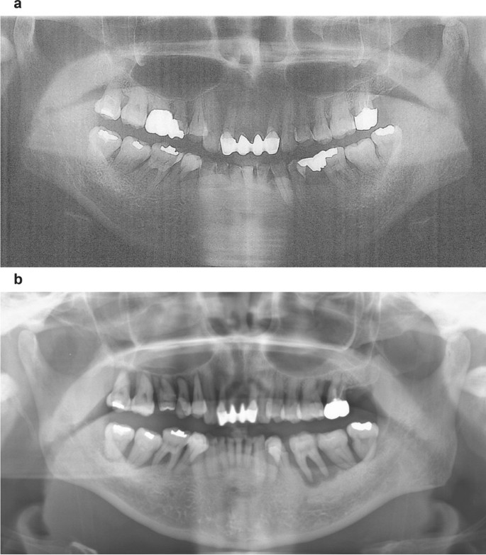 alveolar bone loss