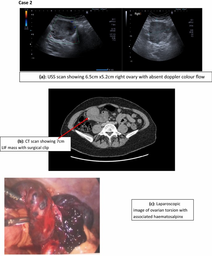 Acute Adnexa with Preserved Flow to the Ovary: Could Isolated Tubal Torsion  Be the Cause? - Journal of Pediatric and Adolescent Gynecology, image size:685x825