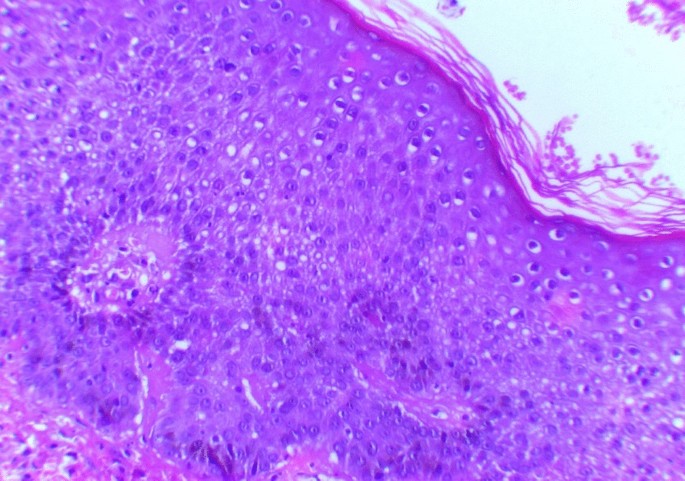Pyoderma gangrenosum associated with granulomatosis with polyangiitis ...