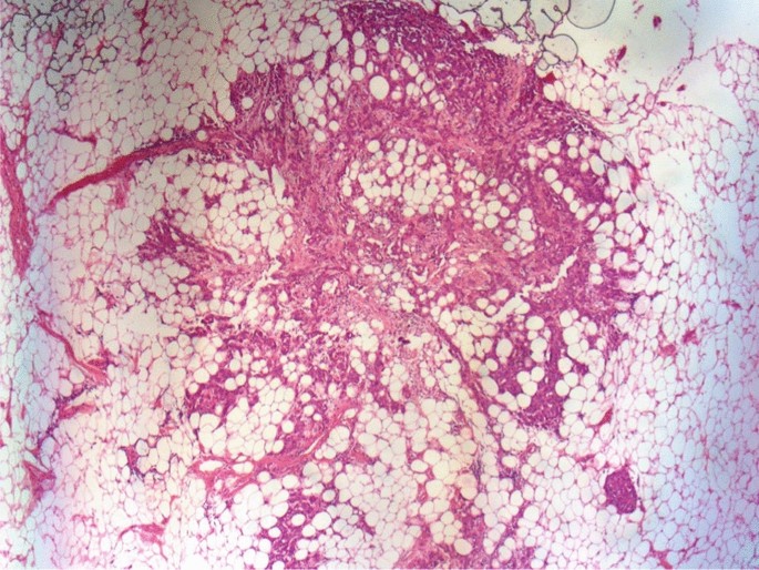 Axillary tumor deposits in primary breast carcinoma: a case report – Journal of Medical Case Reports