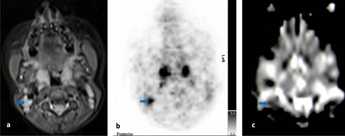 Nasopharynx and Waldeyer's Ring