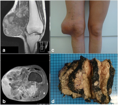 cancer of sarcoma)