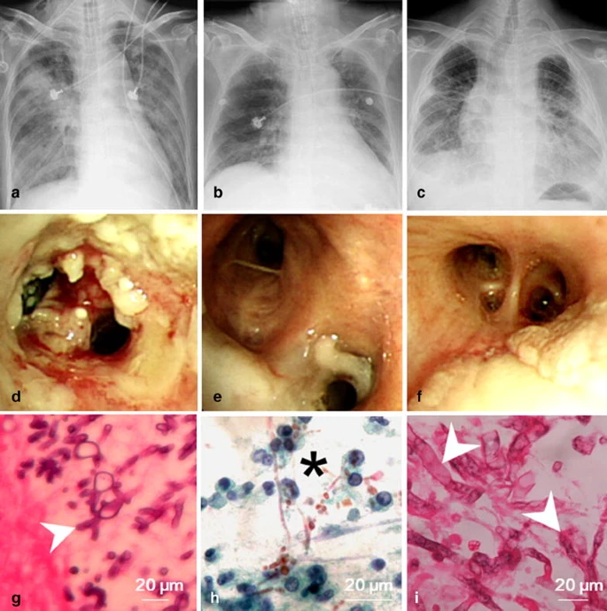 Invasive fungal tracheobronchitis in mechanically ventilated critically ill patients: underlying conditions, diagnosis, and outcomes
