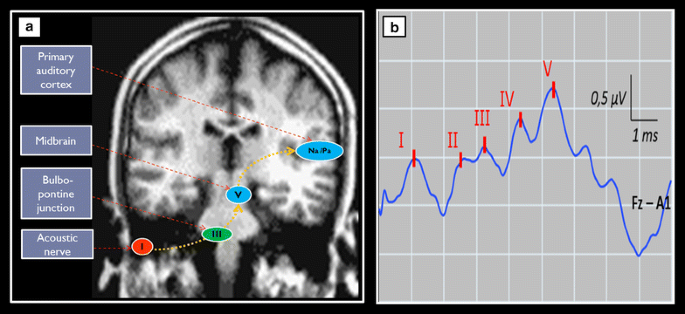 Automated cortical auditory evoked potentials threshold estimation in  neonates☆