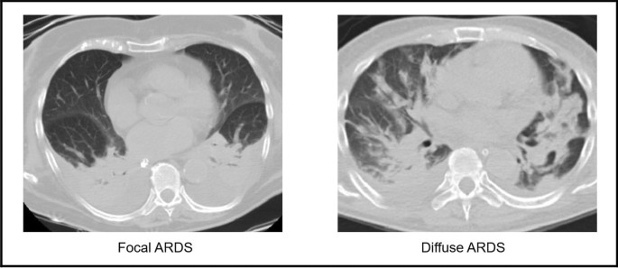 Radiological pattern in ARDS patients: partitioned respiratory mechanics,  gas exchange and lung recruitability | Annals of Intensive Care | Full Text