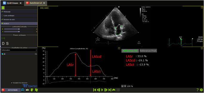 PDF] Normal values and clinical relevance of left atrial myocardial  function analysed by speckle-tracking echocardiography: multicentre study.