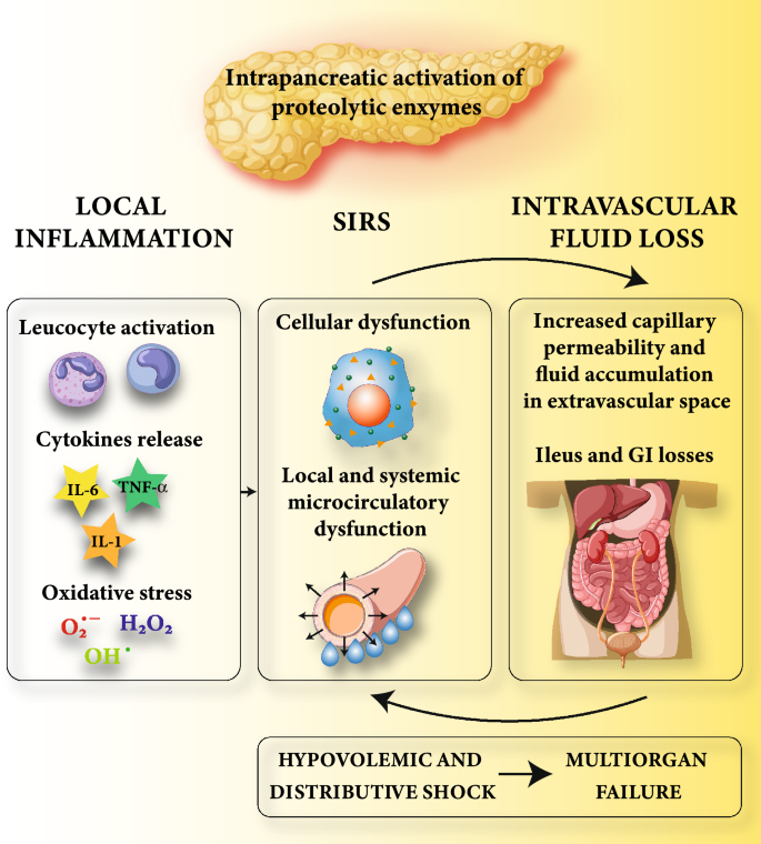 Intravenous fluid therapy in patients with severe acute pancreatitis admitted to the intensive care unit: a narrative review | Annals of Intensive Care | Full Text Intravenous fluid therapy in patients with severe acute pancreatitis admitted to the intensive care unit: a narrative review | Annals of Intensive Care | Full Text