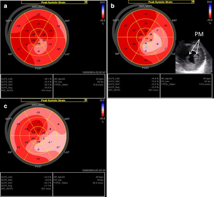 Longitudinal strain bull's eye plot patterns in patients with  cardiomyopathy and concentric left ventricular hypertrophy, European  Journal of Medical Research