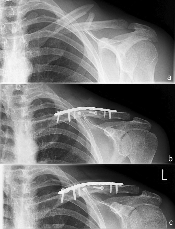 PLAQUE DE COMPRESSION VERROUILLABLE DE RECONSTRUCTION CLAVICLE 3,5 MM