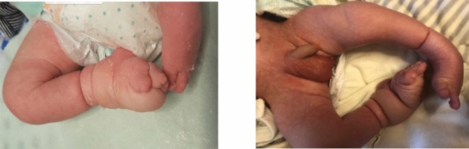 Clubfeet And Congenital Constriction Band Syndrome European Journal Of Medical Research Full Text Clubfeet And Congenital Constriction Band Syndrome European Journal Of Medical Research Full Text