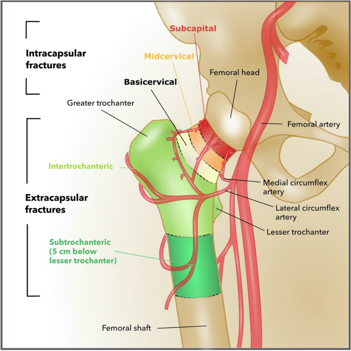 proximal femur fracture
