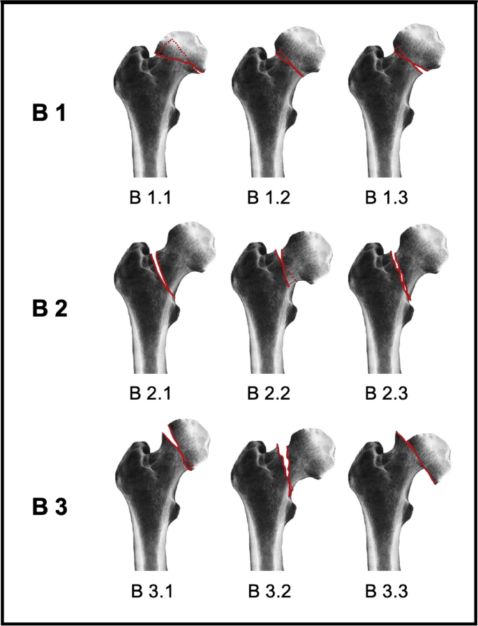 Management Of Proximal Femur Fractures In The Elderly Current Concepts And Treatment Options European Journal Of Medical Research Full Text