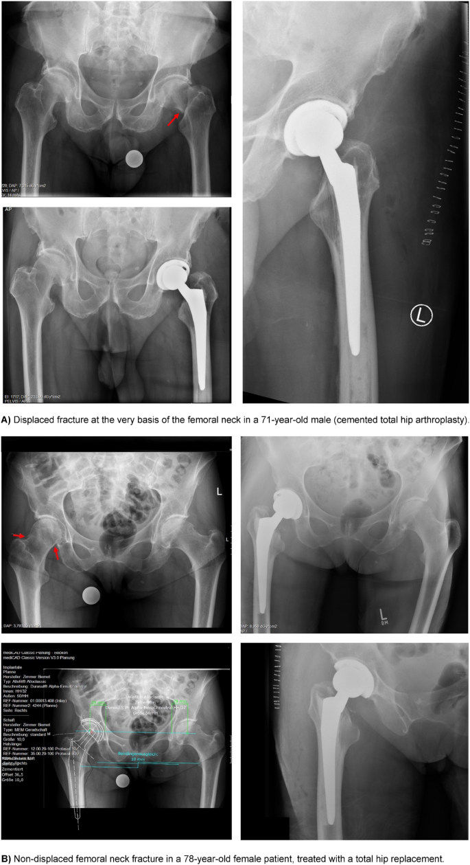 Figure 3 from Surgical Treatment of Undisplaced Femur Neck Fractures in  Dementia Patients Using Proximal Femoral Nail Antirotation | Semantic  Scholar