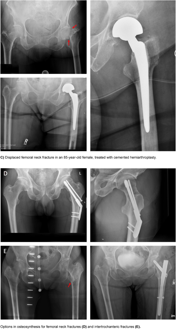 Are Cephalomedullary Nail Guides Accurate? A Case Report of an Unexpected  Complication After Nailing an Intertrochanteric Femoral Fracture - Rayan  Fairag, Fahad H. Abduljabbar, Alex Page, Ron Dimentberg, 2018