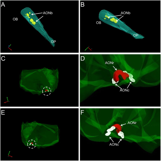 The Human Olfactory System In Two Proteinopathies Alzheimer S And Parkinson S Diseases Translational Neurodegeneration Full Text