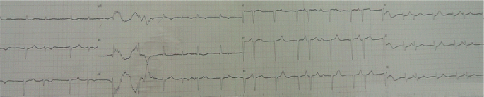 Electrocardiographic Changes Caused By Lithium Intoxication In An Elderly Patient Springerplus Full Text