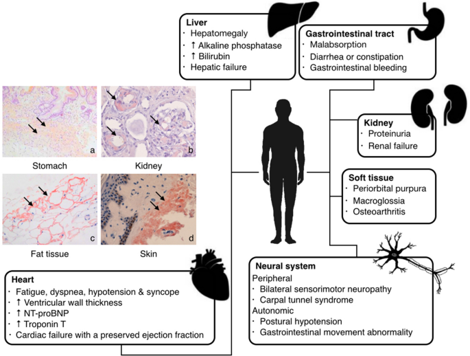 Løfte religion forlænge Genetic pathogenesis of immunoglobulin light chain amyloidosis: basic  characteristics and clinical applications | Experimental Hematology &  Oncology | Full Text