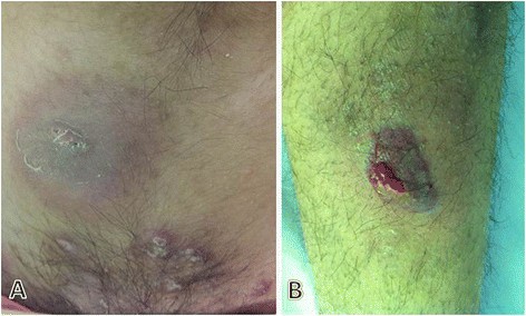 Isotretinoin-associated Sweet&rsquo;s syndrome: a case report | DARU 