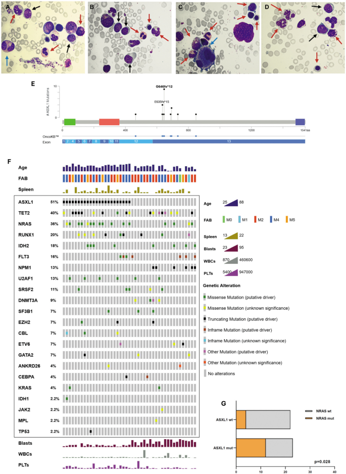 Splenomegaly in de novo acute myeloid leukemia is associated with ASXL1 ...
