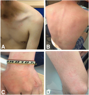 neuroendocrine cancer of the skin)