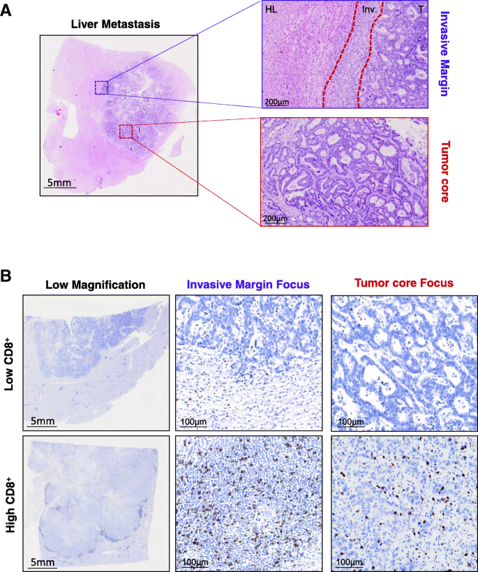 Ras Status And Neoadjuvant Chemotherapy Impact Cd8 Cells And Tumor Hla Class I Expression In Liver Metastatic Colorectal Cancer Journal For Immunotherapy Of Cancer Full Text