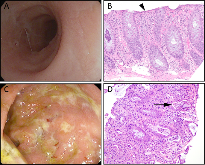 Budesonide treatment for microscopic colitis from immune checkpoint  inhibitors | Journal for ImmunoTherapy of Cancer | Full Text