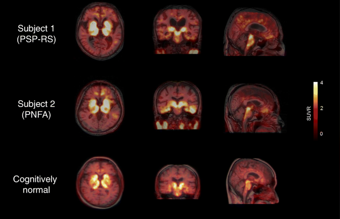 Neuroimaging-pathological correlations of [18F]THK5351 PET in progressive  supranuclear palsy | Acta Neuropathologica Communications | Full Text
