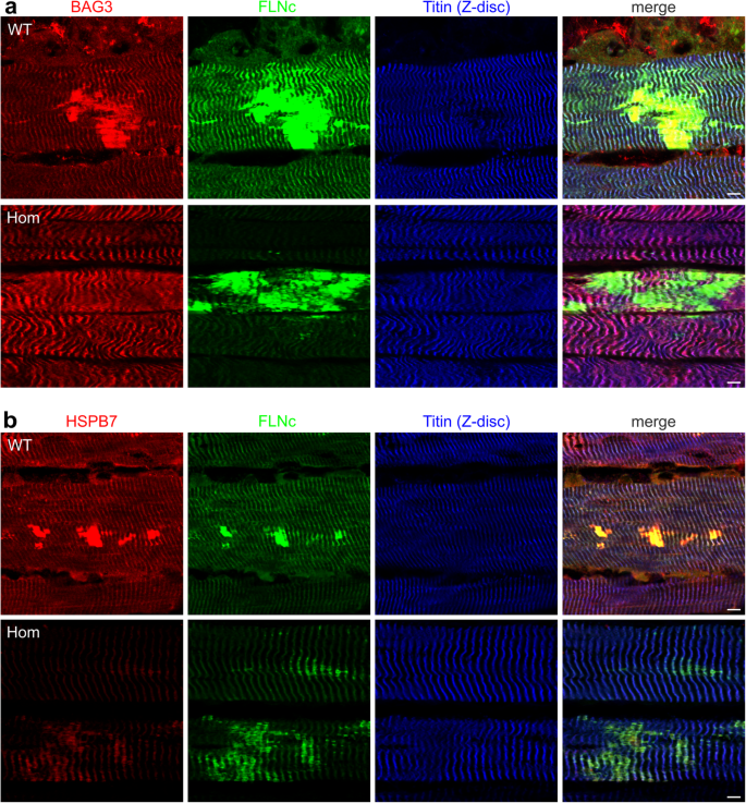 FLNC-Associated Myofibrillar Myopathy