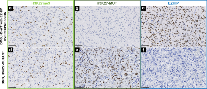 Ezhip Is A Specific Diagnostic Biomarker For Posterior Fossa Ependymomas Group Pfa And Diffuse Midline Gliomas H3 Wt With Ezhip Overexpression Acta Neuropathologica Communications X Mol