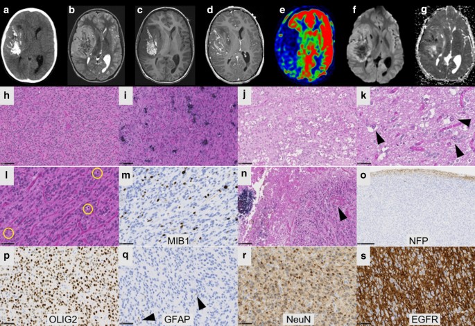 The Ep300 or Fusion Extends The Genetic Alteration Spectrum Defining The New Tumoral Entity Of Cns Tumors With or Internal Tandem Duplication Acta Neuropathologica Communications X Mol