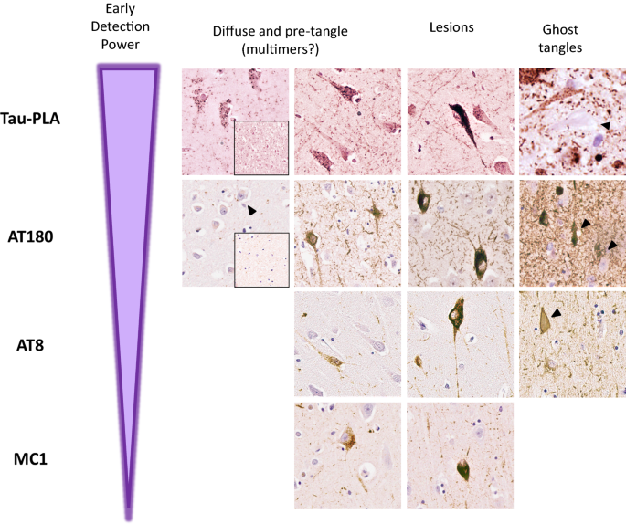 Tau-proximity ligation assay reveals extensive previously undetected  pathology prior to neurofibrillary tangles in preclinical Alzheimer's  disease | Acta Neuropathologica Communications | Full Text