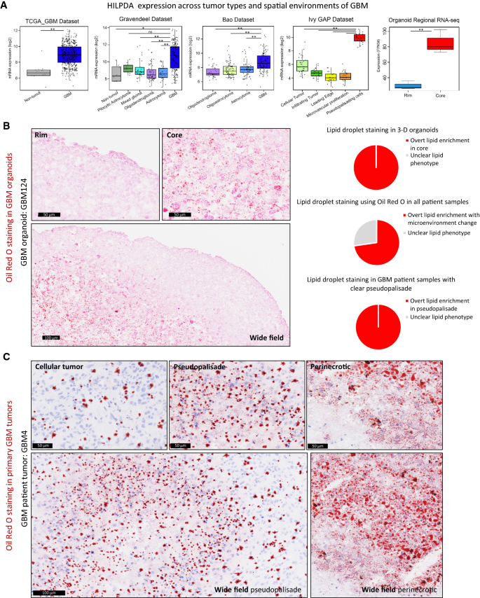 Altered Lipid Metabolism Marks Glioblastoma Stem And Non Stem Cells In Separate Tumor Niches Acta Neuropathologica Communications Full Text