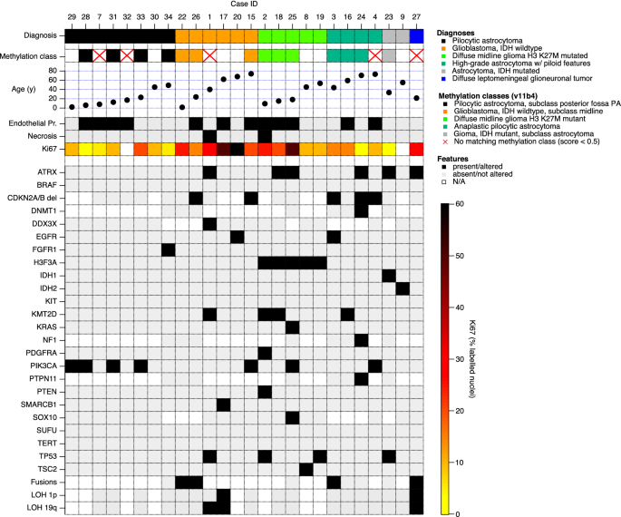 anaplastic astrocytoma versus dmg anaplastic astrocytoma versus dmg