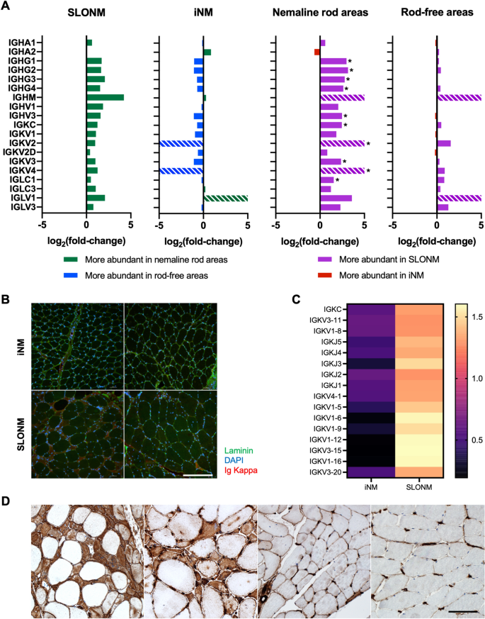 Molecular signatures of inherited and acquired sporadic late onset