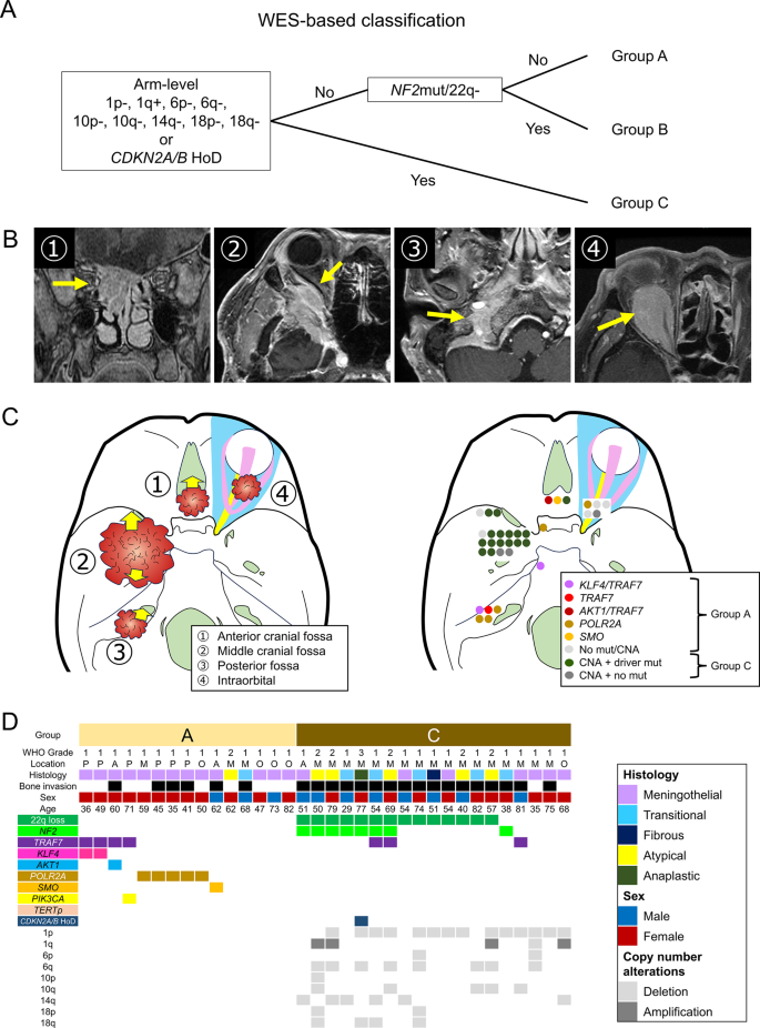 Two molecular subtypes of skull base meningiomas with extracranial ...