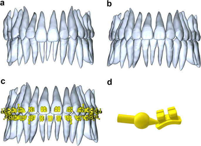 A Novel Customized Ceramic Bracket For Esthetic Orthodontics In Vitro Study Progress In Orthodontics Full Text