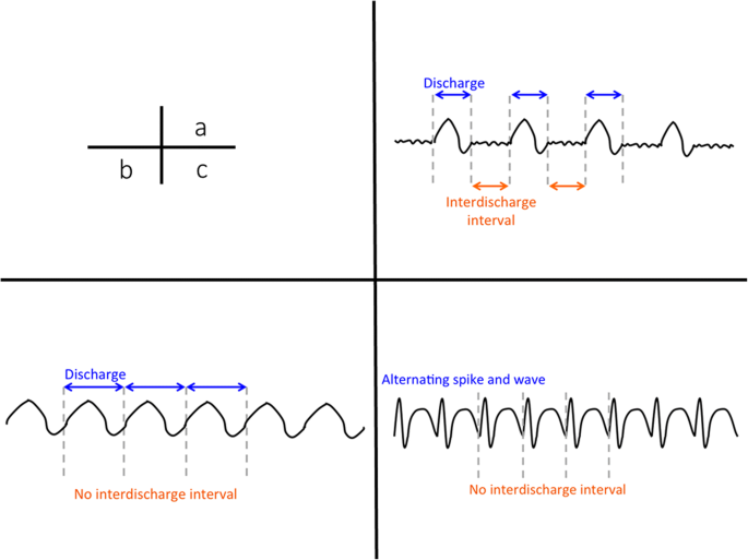 eeg seizure pattern eeg seizure pattern