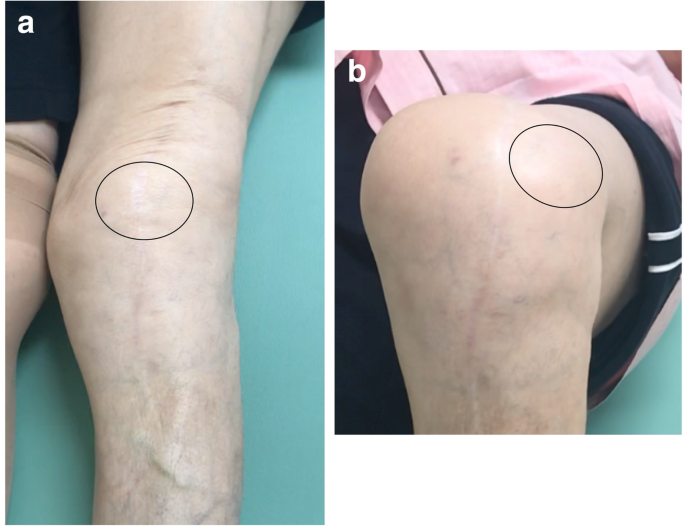 Successful treatment of habitual patellar dislocation after total knee arthroplasty with a closing-wedge distal femoral varus osteotomy and medial patello-femoral ligament reconstruction | of Experimental Orthopaedics | Full Text