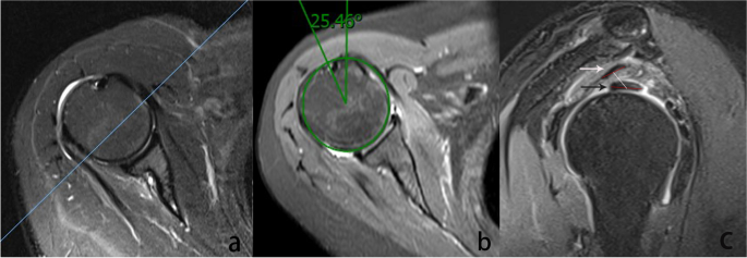 Distance between the supraspinatus and long head of the biceps 