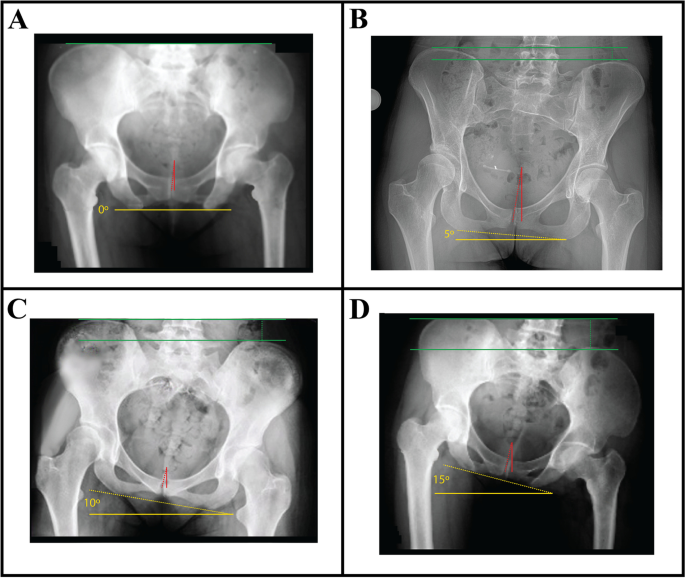 pelvic tilt xray