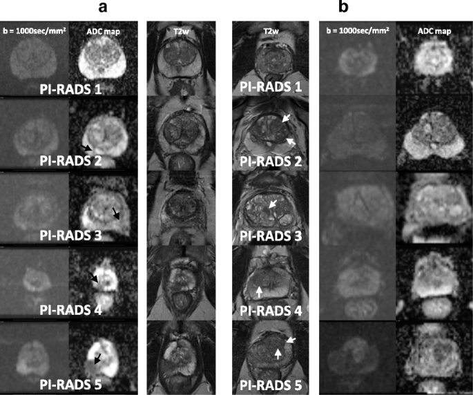MULTIPARAMETRIC MR IMAGING OF PROSTATE TUMORS: PI-RADS V, Normal prostate mri images