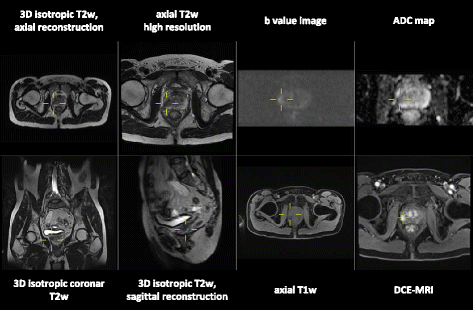 how to read prostate mri