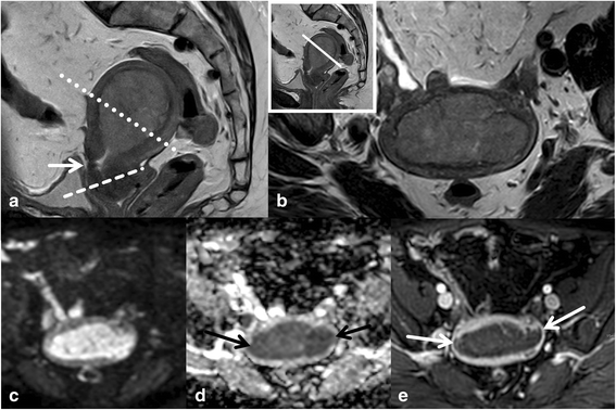 Endometrium rák mri. Endometrium daganatok, endometriumrák tünetei, kivizsgálása