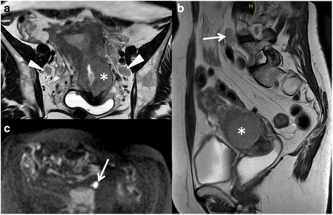 endometrium rák az MR-n)