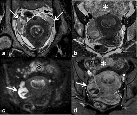 Endometrium rák a ct-n. A méhtestrák tünetei, kezelése