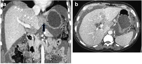 CT in ovarian cancer staging: how to review and report with emphasis on  abdominal and pelvic disease for surgical planning | Cancer Imaging | Full  Text