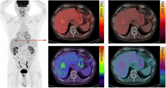 How We Read Oncologic FDG PET/CT | Cancer Imaging | Full Text