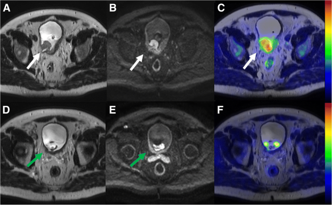 11 C Acetate Pet Mri In Bladder Cancer Staging And Treatment Response Evaluation To Neoadjuvant Chemotherapy A Prospective Multicenter Study Acebib Trial Cancer Imaging Full Text